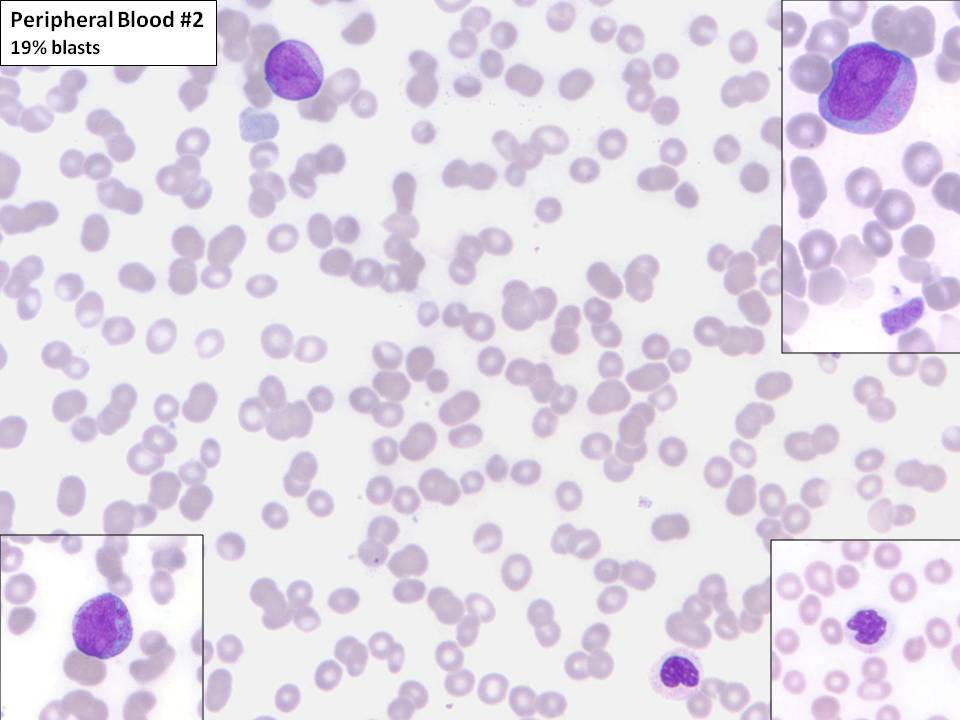Peripheral blood #2: Circulating blasts are present comprising 19% of cells. Many of the blasts contain cytoplasmic granules. Occasional dysplastic neutrophils are present.